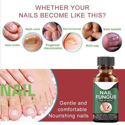Fast Nail Fungal Treatment Serum